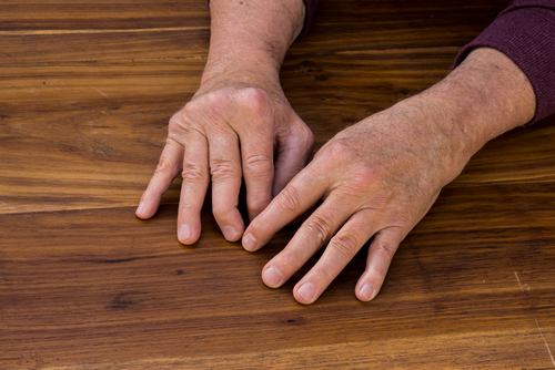 Arthrite psoriasique : quand le psoriasis atteint les articulations