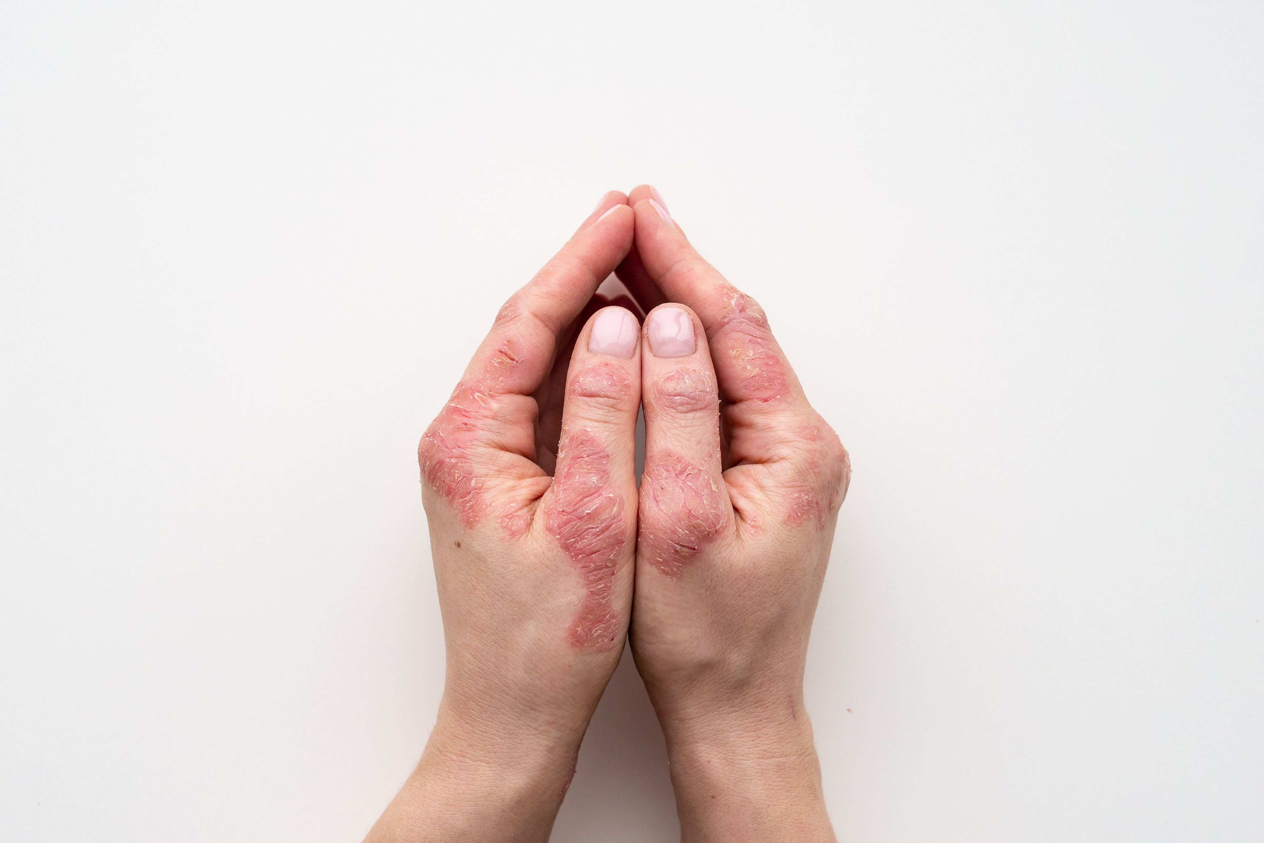 Ces zones du corps que le psoriasis n’épargne pas