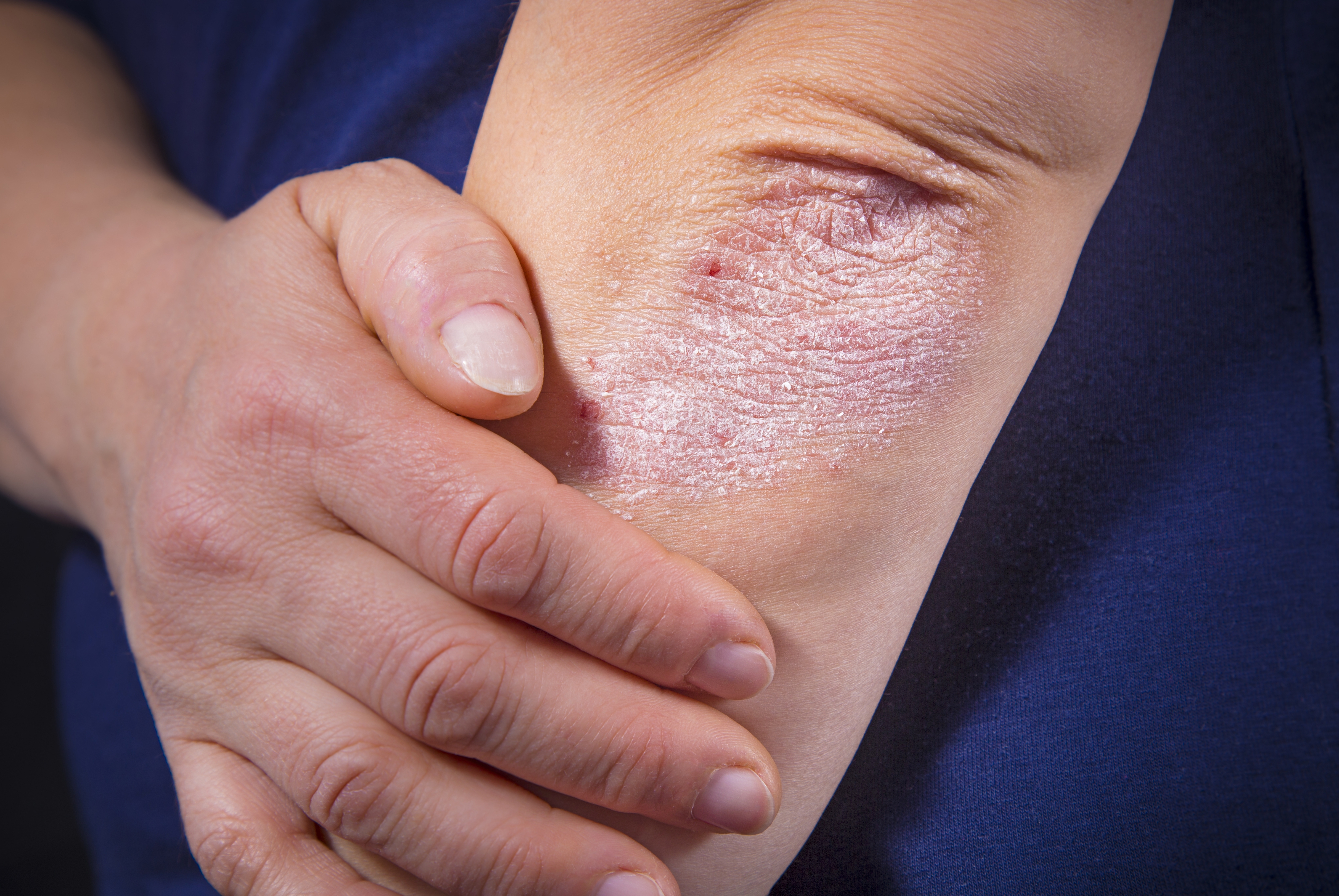 Peut-on guérir du psoriasis?