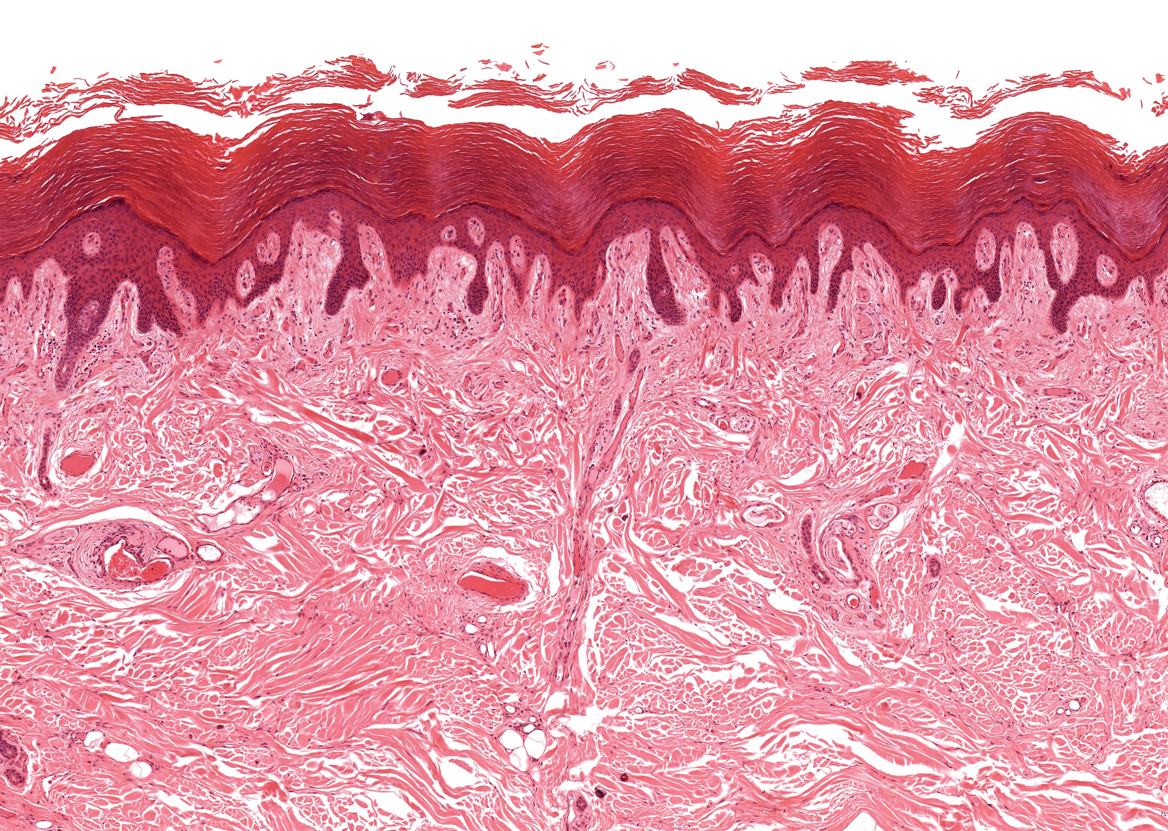 Le psoriasis, plus qu’une histoire de peau